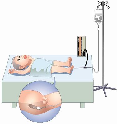 Atropine Premedication Facilitates Ultrasound-Guided Reduction by Saline Enema in Children With Intussusception